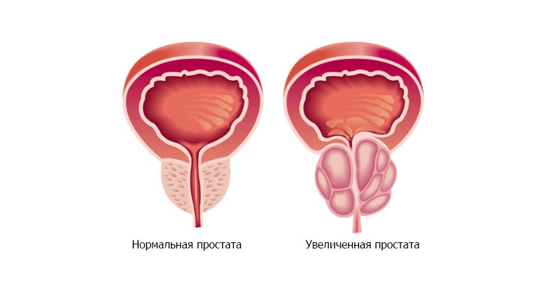 нормальная простата и увеличенная простата 